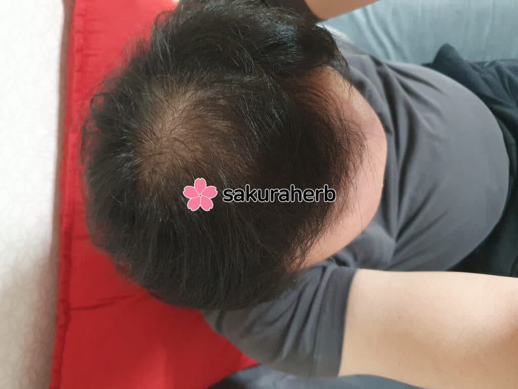 핀페시아 + 녹시딜 2년 후기