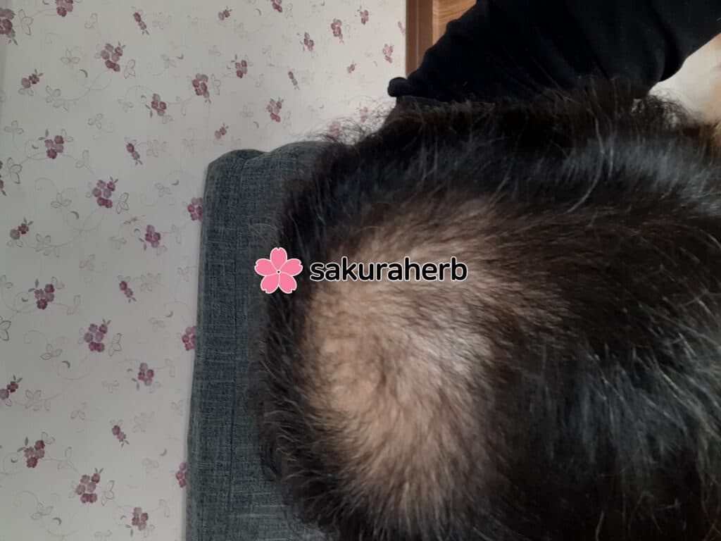 미녹시딜효과
