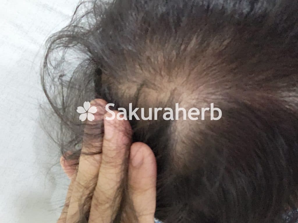 후기 - 에프페시아 (피나스테리드 Finasteride 1mg)