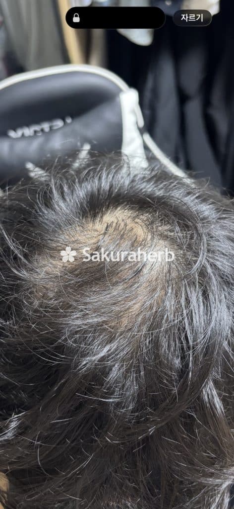후기 - 핀주브 (피나스테리드 Finasteride 1mg)*1400정은 지인과 함께 구매*