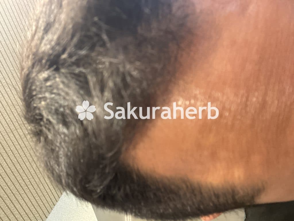 후기 - 에프페시아 (피나스테리드 Finasteride 1mg)