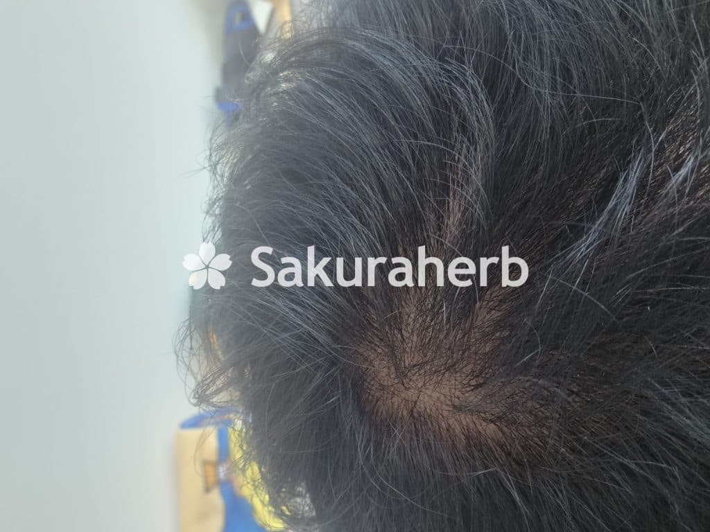 후기 - 녹시딜 포르테 테블릿 (미녹시딜 Minoxidil 10mg)