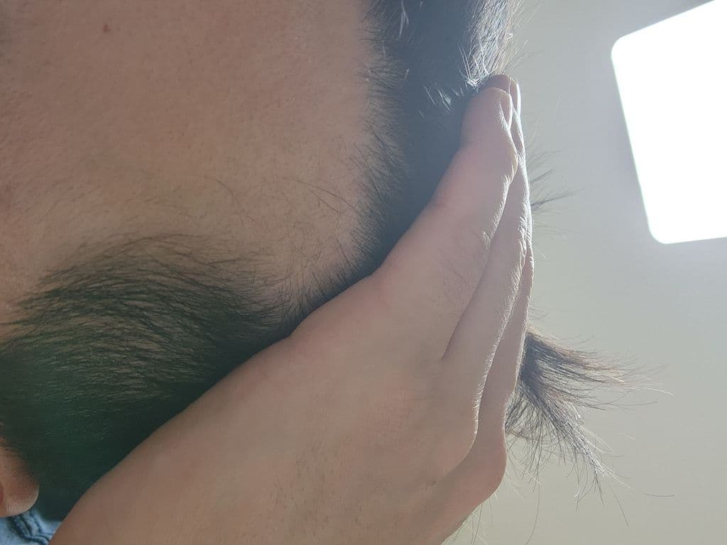 후기 - 핀주브-M ( Finasteride 피나스테리드 1mg + Minoxidil 미녹시딜 5mg ) - 600정